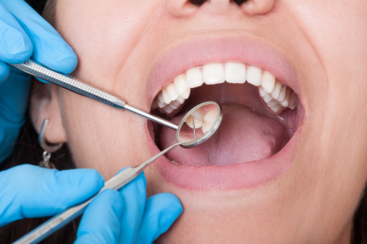 Who Is At Risk of Developing Cavities?