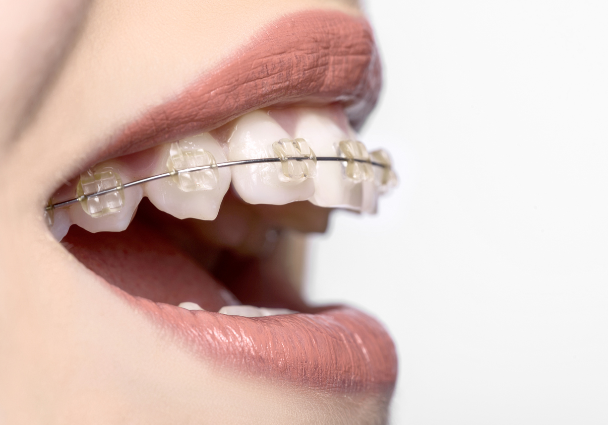 Teeth Straightening And Aligners